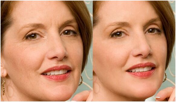до і після плазмового омолодження шкіри обличчя