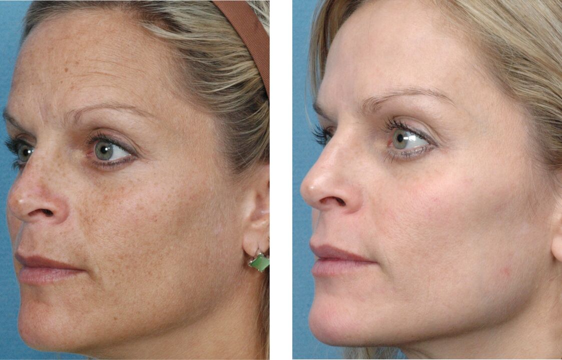 до і після омолодження шкіри фото 1