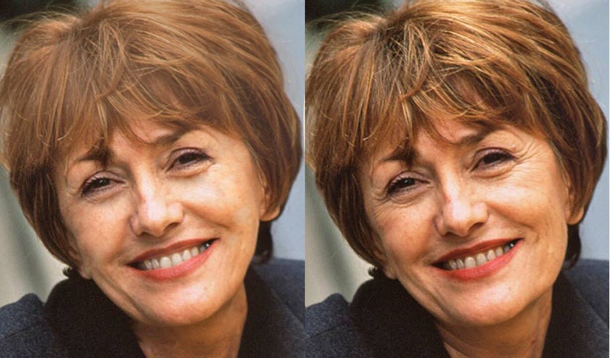 фото особи до і після контурної пластики