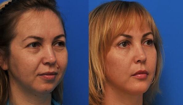 до і після омолодження шкіри підтяжкою фото 1