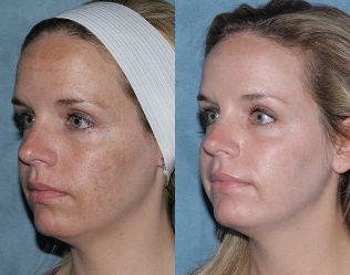 Фото до і після фракційного омолодження обличчя
