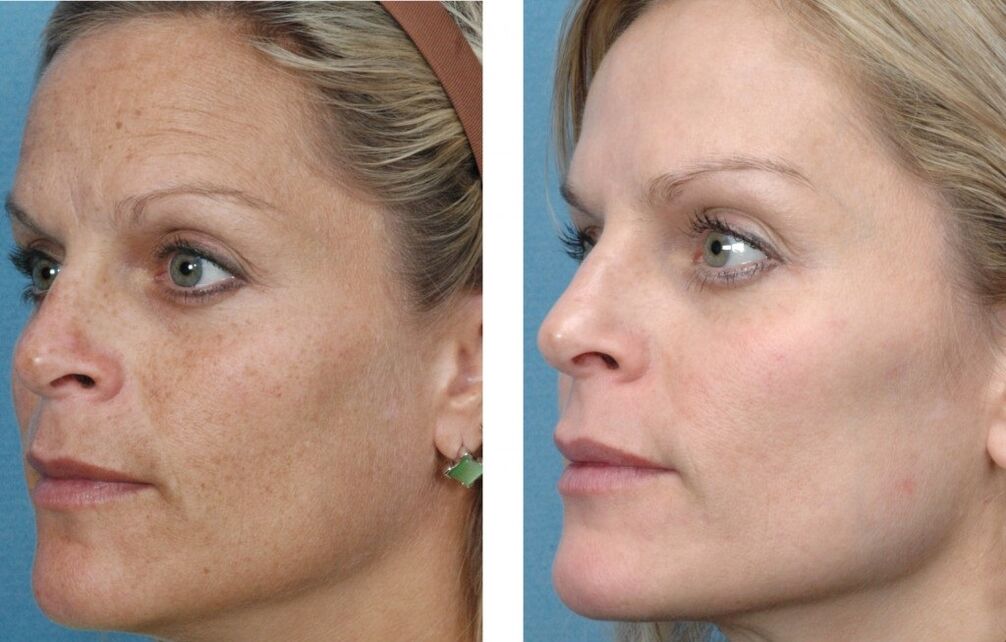 до та після омолодження шкіри обличчя