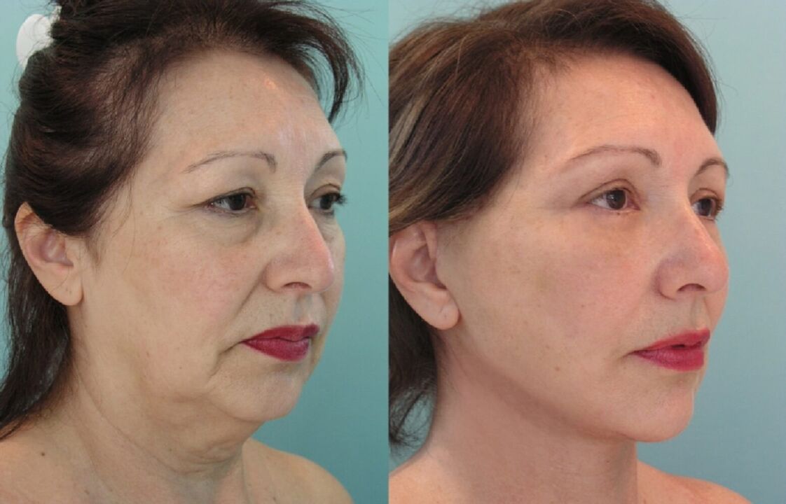 До та після ниткового ліфтингу шкіри обличчя