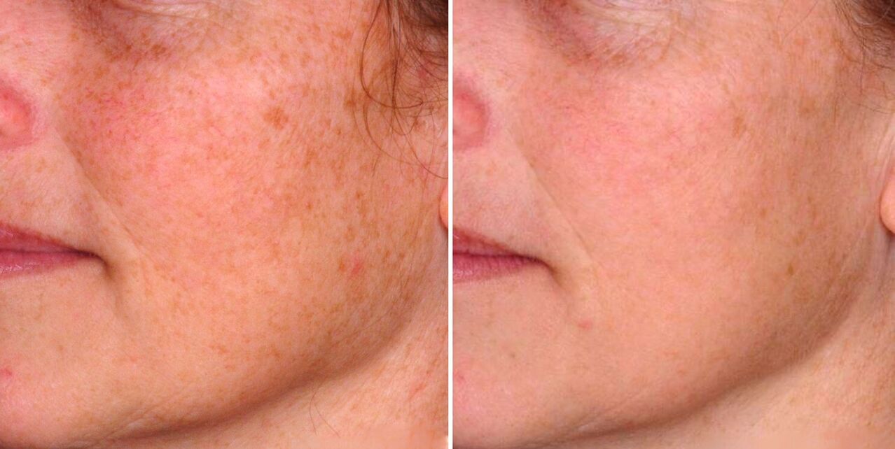 Результат фракційного фототермолізу – зменшення пігментних плям на шкірі обличчя
