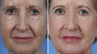 фракційне омолодження шкіри обличчя фото до і після